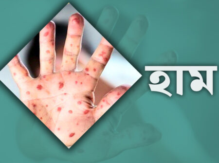 দেশে হামের উপসর্গে ২৪ ঘণ্টায় ৬ শিশুর মৃত্যু